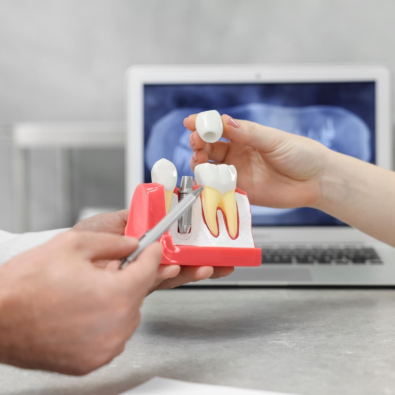 Implantes dentales en A Coruña